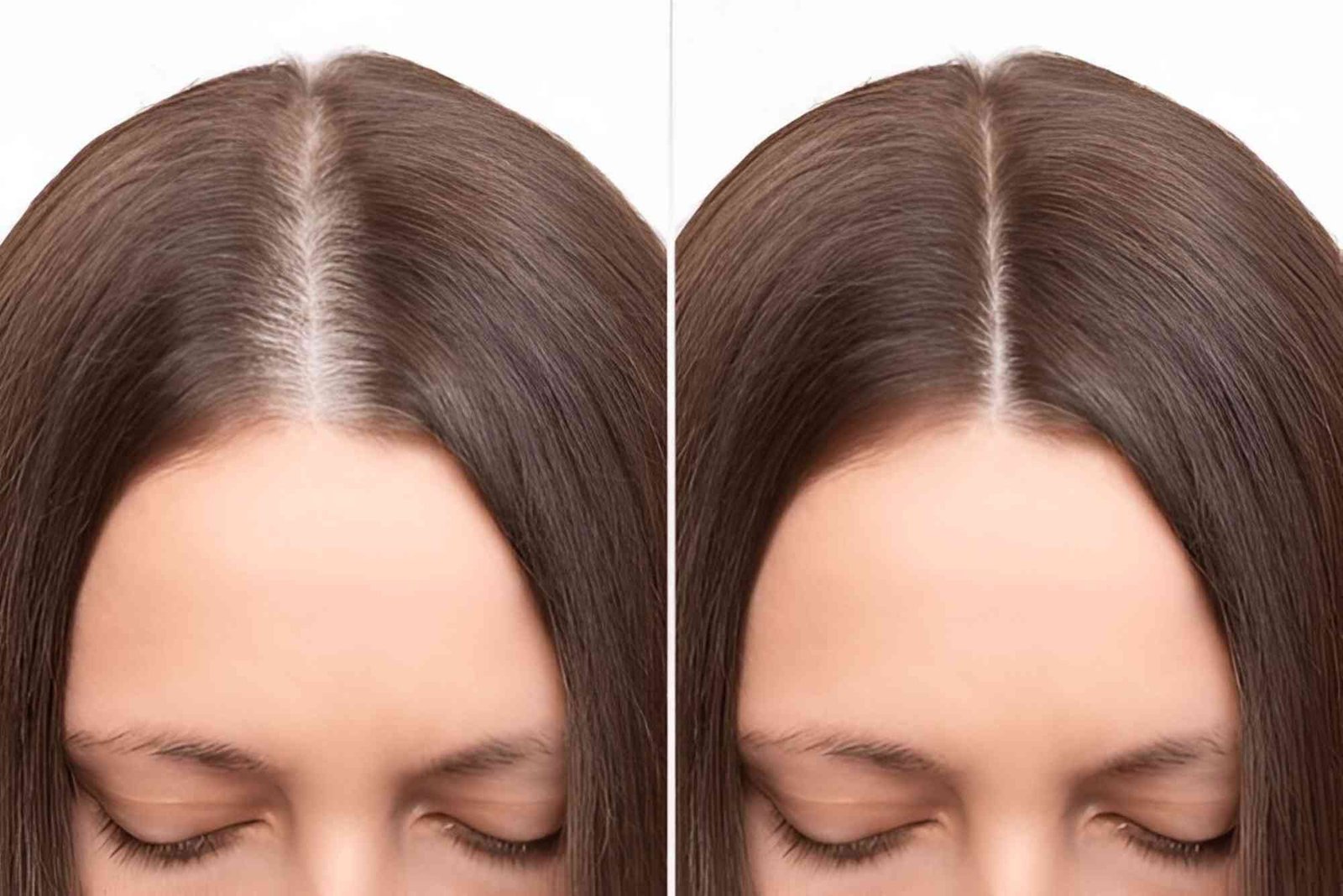 Best Hair Transplat Turkey
